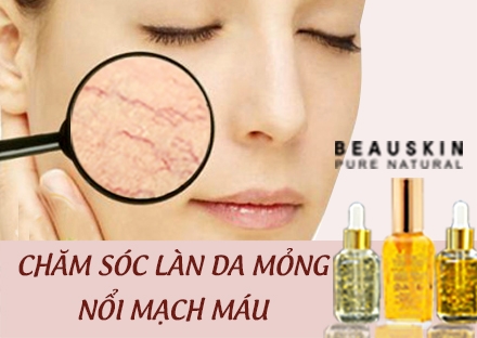 CHĂM SÓC LÀN DA MỎNG NỔI MẠCH MÁU SAO CHO ĐÚNG?
