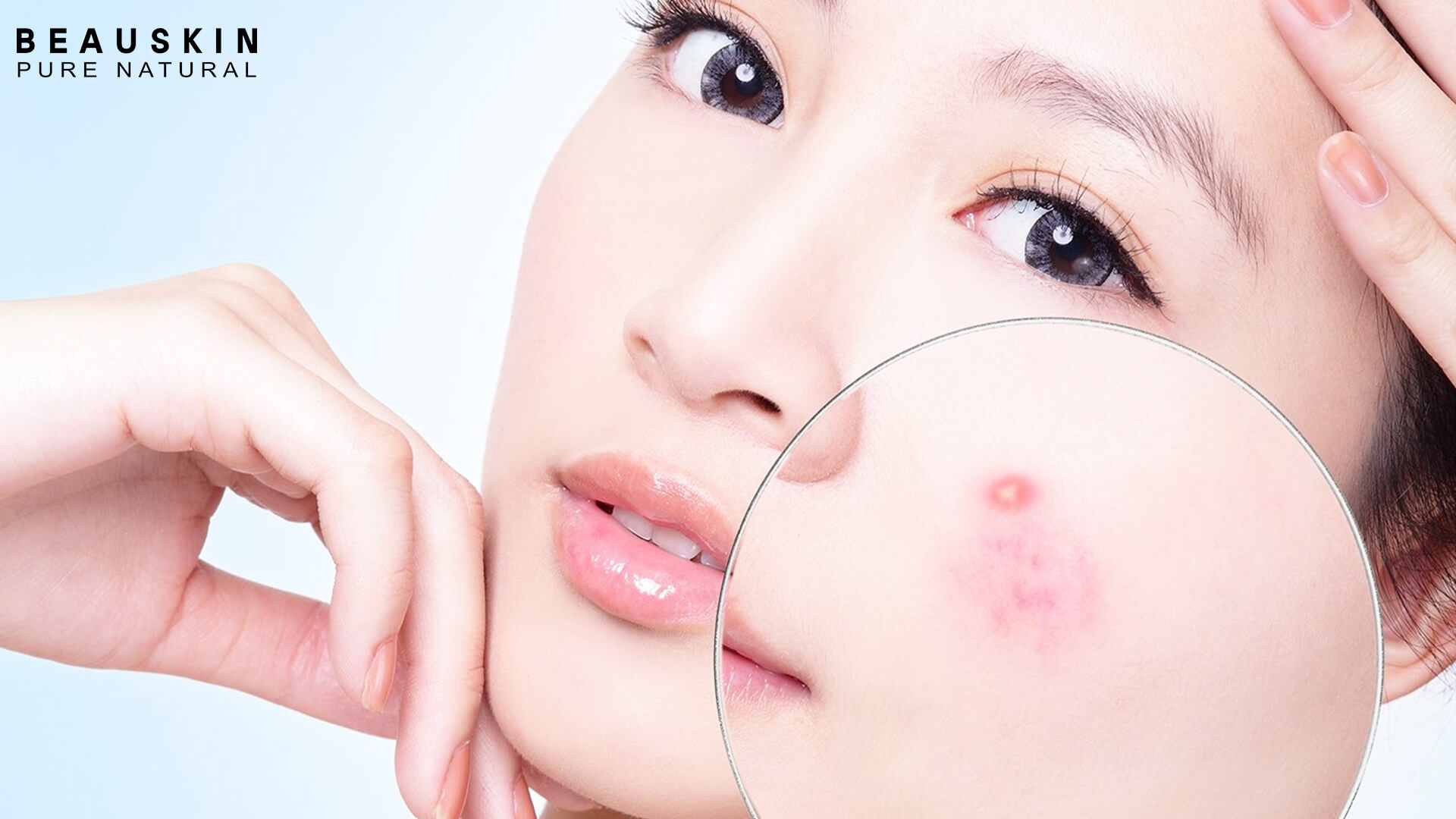 Nước hoa hồng có trị được mụn không?